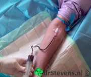 operatietechniek bloedafname bloeddonor bloedplaatjes bio-chirurgie aangezicht - drstevens.nl