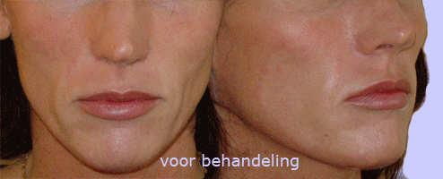 rimpels aquamid injectie gezicht vrouw - drstevens.nl