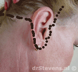 operatietechniek incisie oor liften halslift hals-facelift aangezicht - drstevens.nl