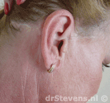 operatietechniek incisie oor halslift hals-facelift aangezicht - drstevens.nl
