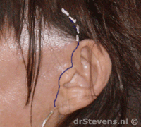 operatietechniek incisie oor litteken hechten macs-lift aangezicht - drstevens.nl