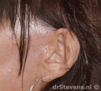 operatietechniek incisie oor macs-lift aangezicht - drstevens.nl