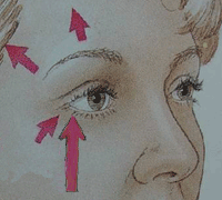 illustratie operatietechniek nieuw correctie uitstraling oogleden aangezicht - drstevens.nl