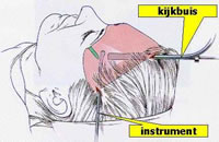 illustratie operatietechniek incisie kijkbuis voorhoofd aangezicht - drstevens.nl