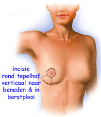 illustratie techniek borsvergroting prothese incisie tepelhof borstplooi - drstevens.nl