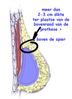 illustratie techniek borsvergroting prothese - drstevens.nl