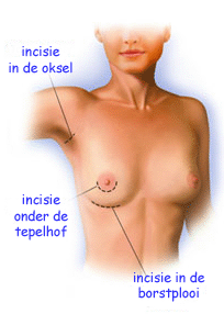 illustratie techniek borsvergroting prothese incisie - drstevens.nl