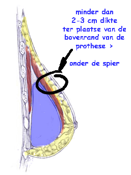 illustratie techniek borsvergroting prothese pectoralis-major - drstevens.nl