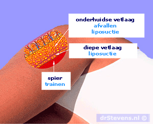 anatomie techniek vetlaag liposuctie - drstevens.nl