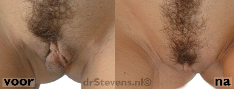 schaamlipcorrectie lipofilling bio-chirurgie vrouw - drstevens.nl