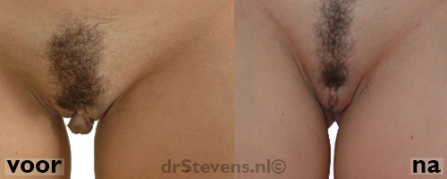 schaamlipcorrectie lipofilling bio-chirurgie vrouw - drstevens.nl