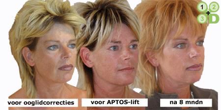 aptos-lift ooglidcorrectie aangezicht vrouw - drstevens.nl