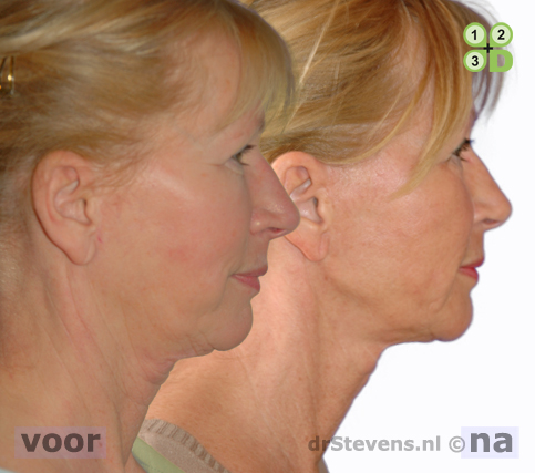 hals-facelift lipofilling wangen aangezicht vrouw - drstevens.nl