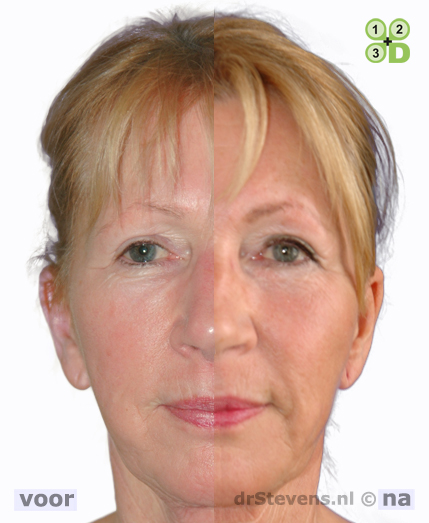 hals-facelift lipofilling wangen aangezicht vrouw - drstevens.nl