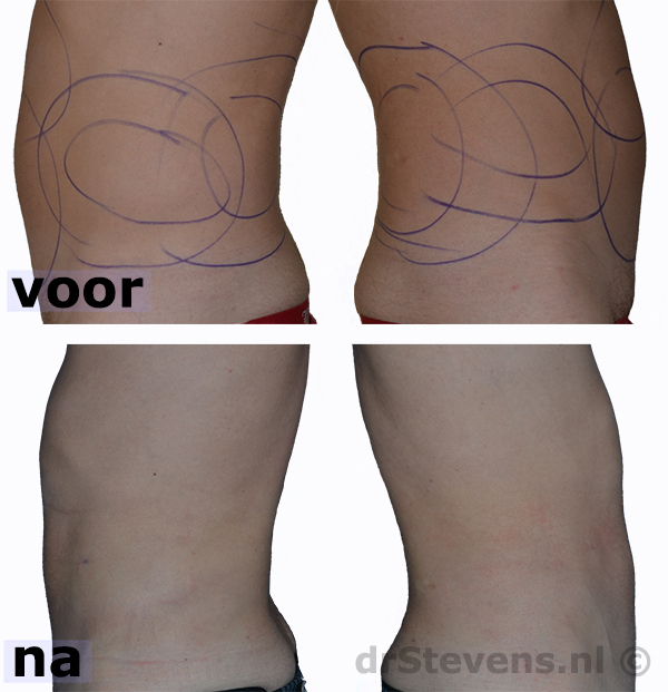 liposuctie buik rug man - drstevens.nl